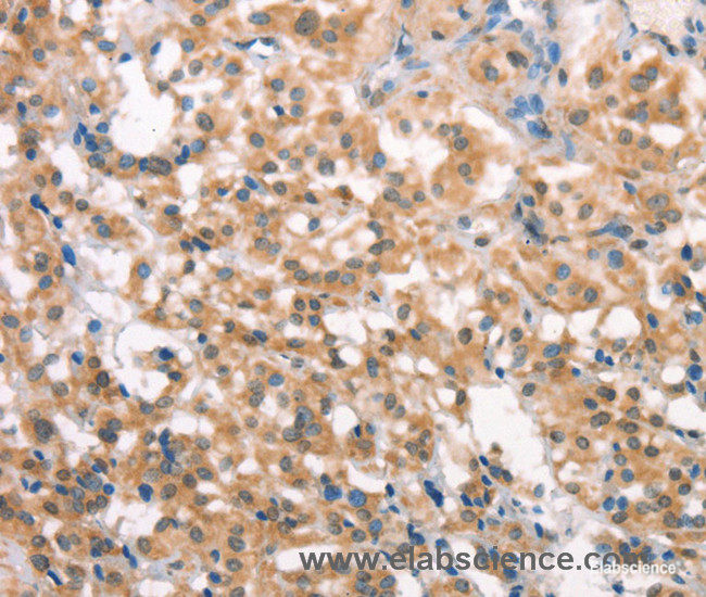 Immunohistochemistry of paraffin-embedded Human thyroid cancer tissue using LATS2 Polyclonal Antibody at dilution 1:30