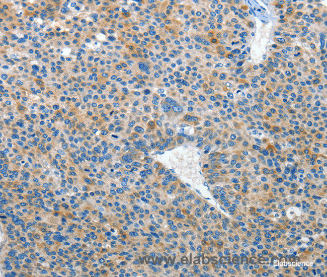 Immunohistochemistry of paraffin-embedded Human liver cancer tissue using EPHB3 Polyclonal Antibody at dilution 1:50