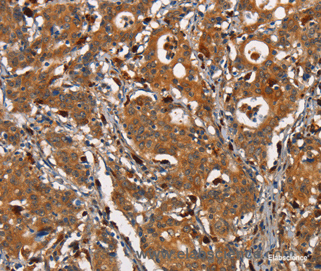 Immunohistochemistry of paraffin-embedded Human gastric cancer tissue using CEACAM3 Polyclonal Antibody at dilution 1:30