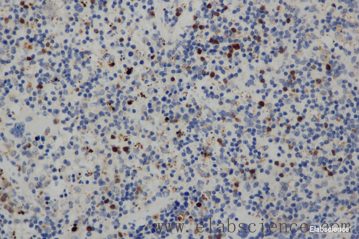 Immunohistochemistry of paraffin-embedded Human cervical cancer tissue using CD68 Polyclonal Antibody at dilution 1:30