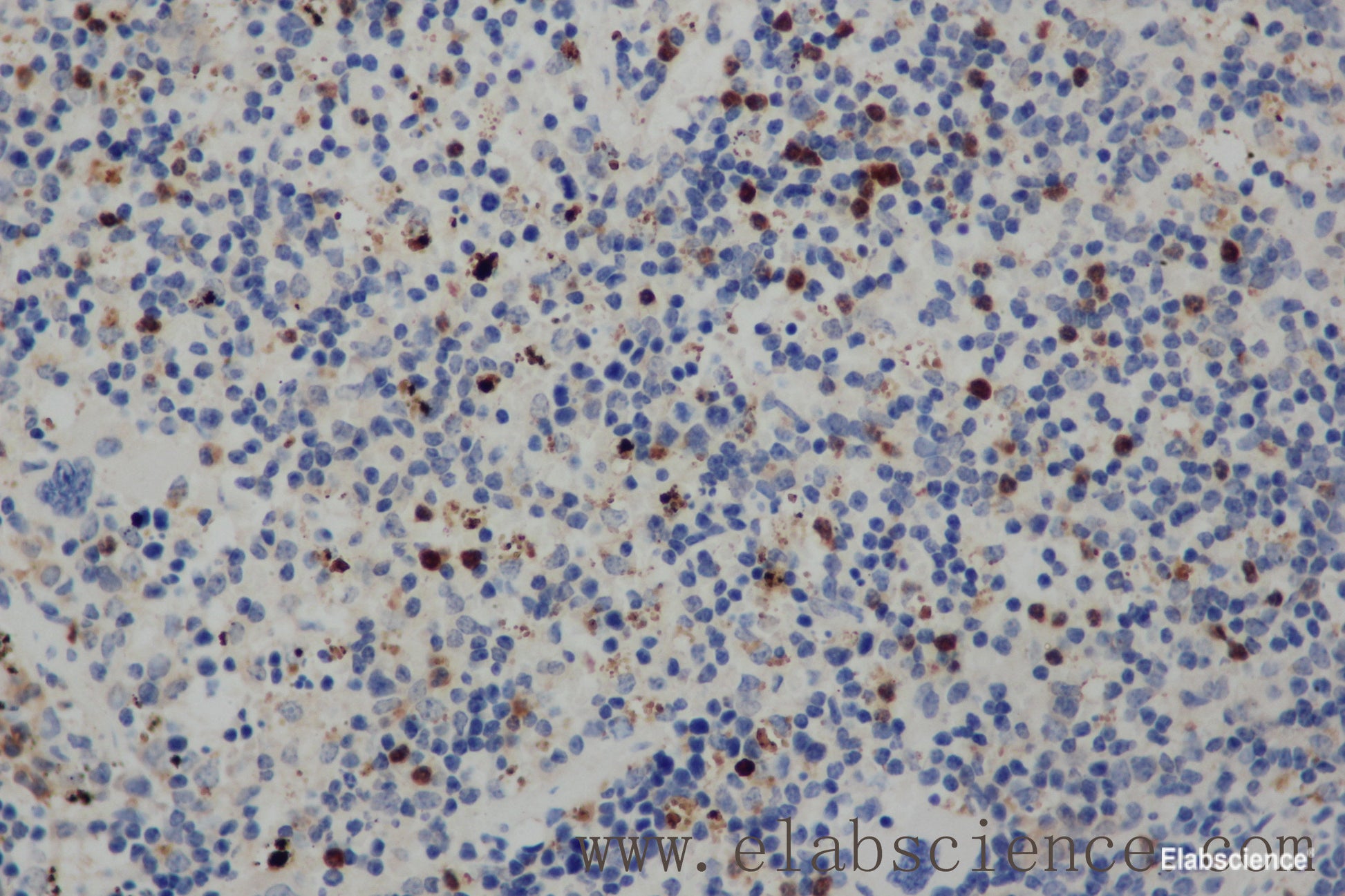 Immunohistochemistry of paraffin-embedded Human cervical cancer tissue using CD68 Polyclonal Antibody at dilution 1:30