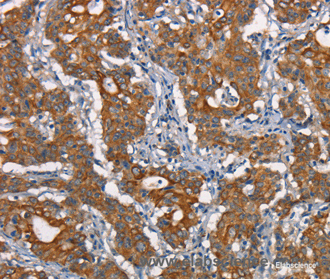 Immunohistochemistry of paraffin-embedded Human gasrtic cancer tissue using CDC23 Polyclonal Antibody at dilution 1:50