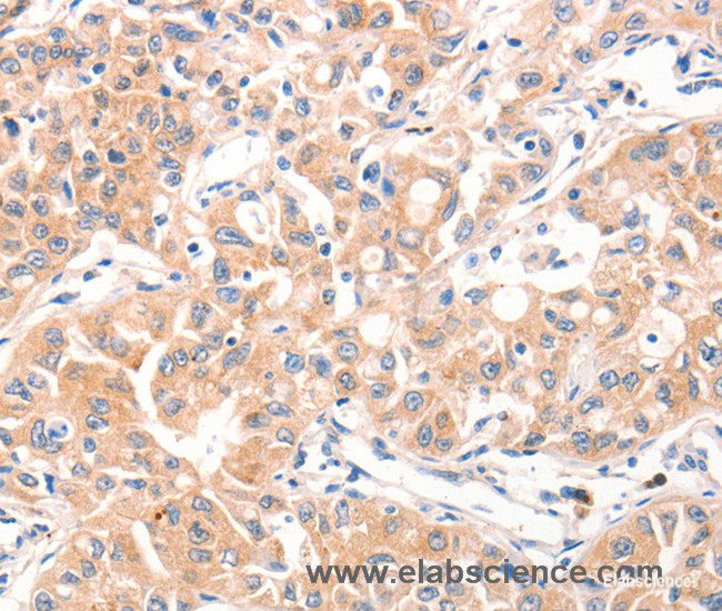 Immunohistochemistry of paraffin-embedded Human ovarian cancer tissue using MUC2 Polyclonal Antibody at dilution 1:60