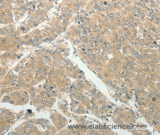 Immunohistochemistry of paraffin-embedded Human liver cancer tissue using SLC8A3 Polyclonal Antibody at dilution 1:50