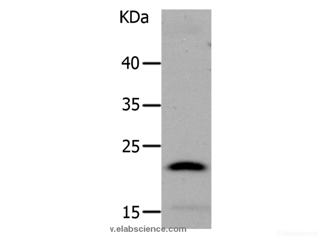 Western Blot analysis of Human liver cancer tissue using LCN2 Polyclonal Antibody at dilution of 1:1050
