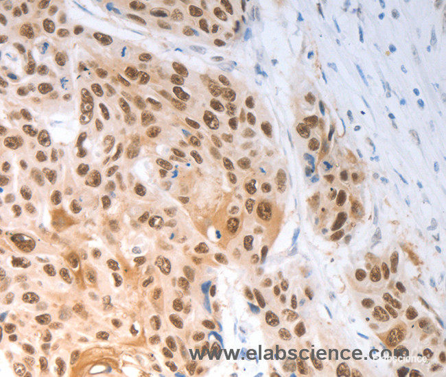 Immunohistochemistry of paraffin-embedded Human ovarian cancer tissue using SLC22A8 Polyclonal Antibody at dilution 1:70