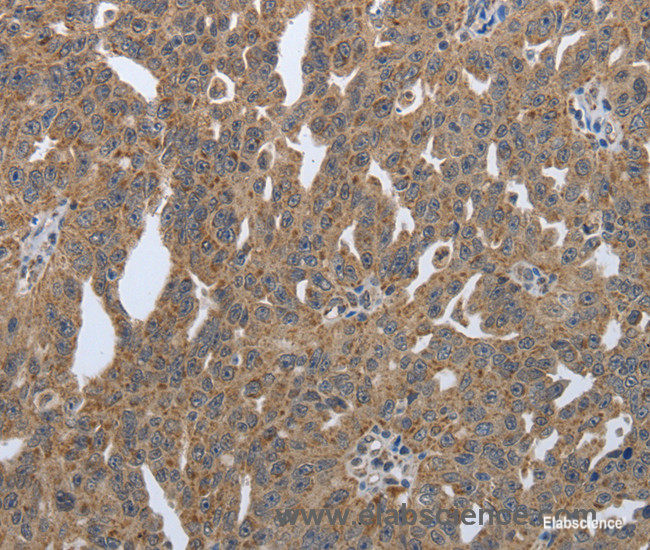 Immunohistochemistry of paraffin-embedded Human ovarian cancer tissue using PDIA2 Polyclonal Antibody at dilution 1:50