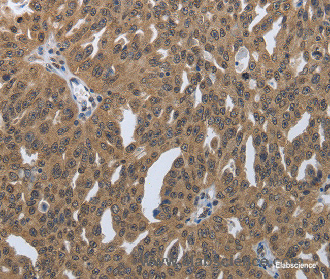 Immunohistochemistry of paraffin-embedded Human ovarian cancer tissue using PRKAR1B Polyclonal Antibody at dilution 1:60