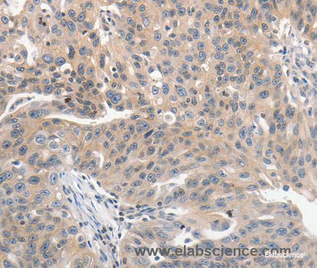 Immunohistochemistry of paraffin-embedded Human ovarian cancer tissue using PRKD1 Polyclonal Antibody at dilution 1:70
