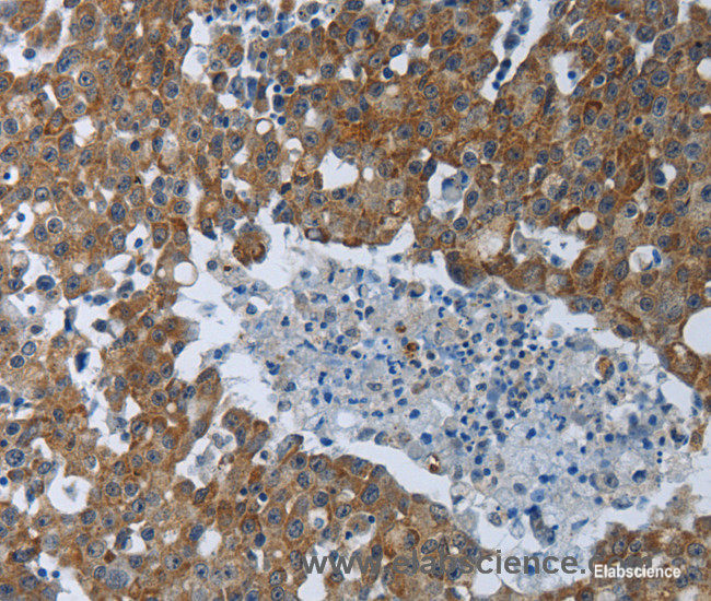 Immunohistochemistry of paraffin-embedded Human breast cancer tissue using EIF2AK2 Polyclonal Antibody at dilution 1:60
