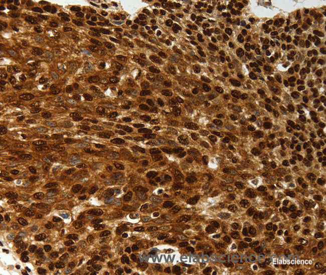 Immunohistochemistry of paraffin-embedded Human cervical cancer tissue using SCN1A Polyclonal Antibody at dilution 1:50