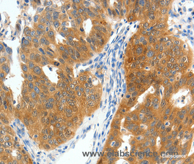 Immunohistochemistry of paraffin-embedded Human ovarian cancer tissue using SCN9A Polyclonal Antibody at dilution 1:40