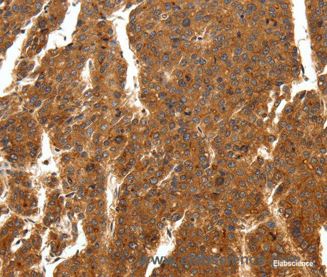 Immunohistochemistry of paraffin-embedded Human breast cancer tissue using SCN11A Polyclonal Antibody at dilution 1:50