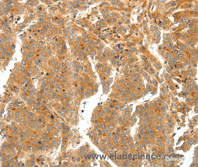 Immunohistochemistry of paraffin-embedded Human liver cancer tissue using SCT Polyclonal Antibody at dilution 1:60