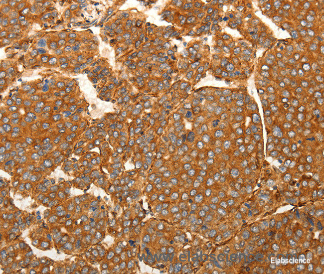 Immunohistochemistry of paraffin-embedded Human liver cancer tissue using SFRP1 Polyclonal Antibody at dilution 1:80