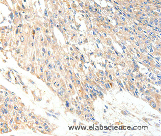 Immunohistochemistry of paraffin-embedded Human esophagus cancer tissue using SLC27A1 Polyclonal Antibody at dilution 1:40