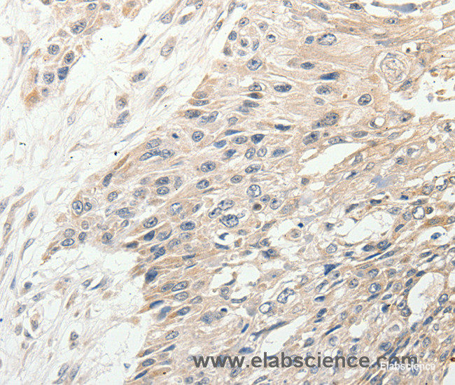 Immunohistochemistry of paraffin-embedded Human esophagus cancer tissue using SLC9A7 Polyclonal Antibody at dilution 1:50