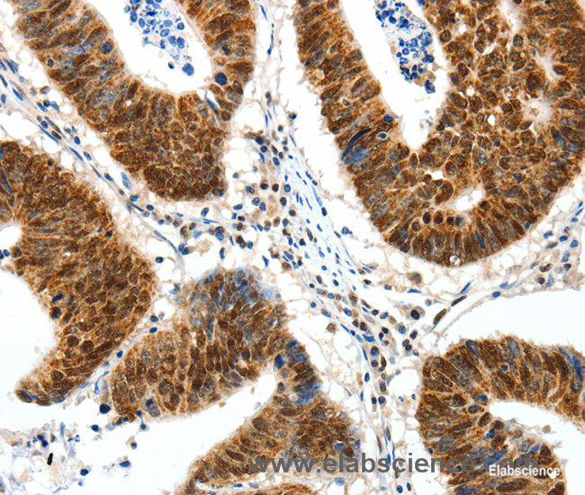 Immunohistochemistry of paraffin-embedded Human colon cancer tissue using SP1 Polyclonal Antibody at dilution 1:30