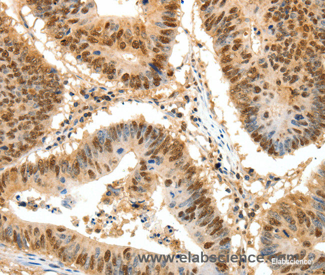 Immunohistochemistry of paraffin-embedded Human colon cancer tissue using SSB Polyclonal Antibody at dilution 1:50