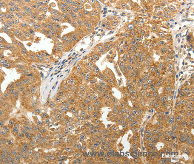Immunohistochemistry of paraffin-embedded Human ovarian cancer tissue using MAP1B  Polyclonal Antibody at dilution 1:40