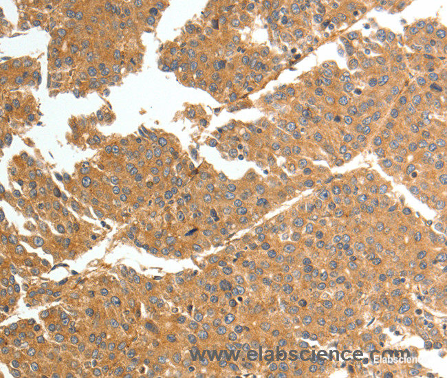 Immunohistochemistry of paraffin-embedded Human liver cancer tissue using TNN Polyclonal Antibody at dilution 1:50