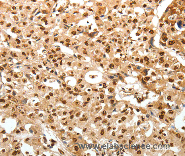 Immunohistochemistry of paraffin-embedded Human ovarian cancer tissue using TNXB Polyclonal Antibody at dilution 1:30