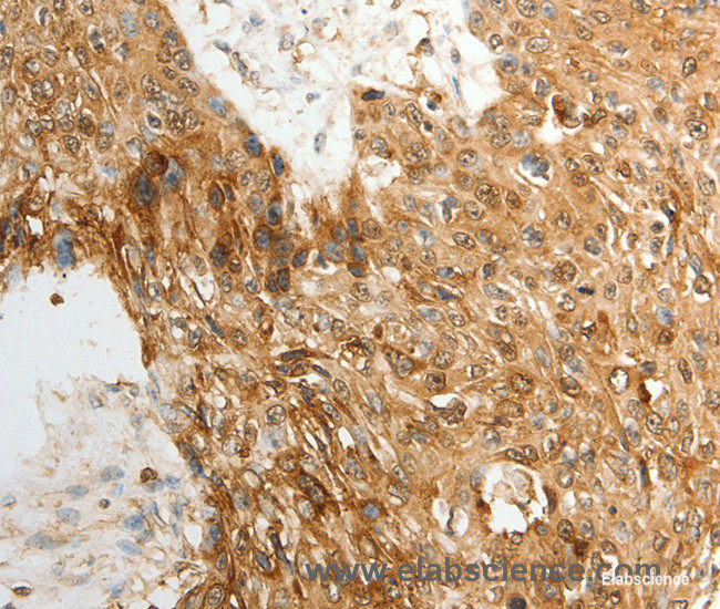 Immunohistochemistry of paraffin-embedded Human esophagus cancer tissue using TENM3 Polyclonal Antibody at dilution 1:50