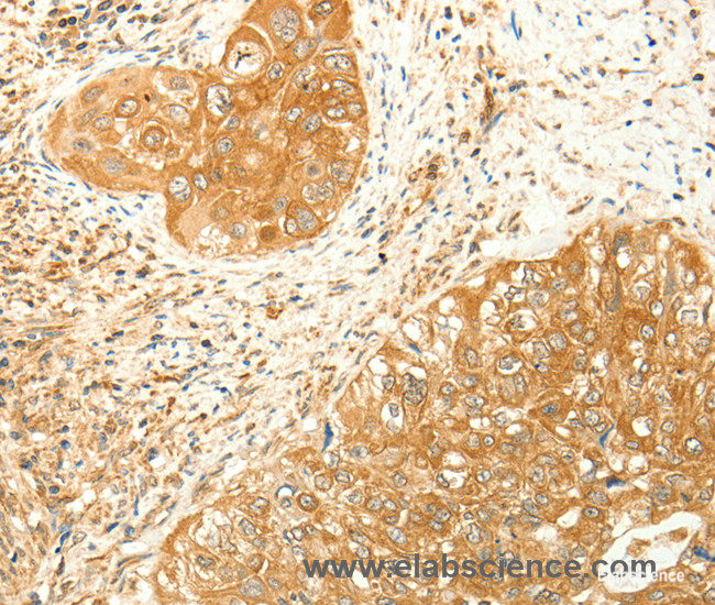 Immunohistochemistry of paraffin-embedded Human cervical cancer tissue using RARRES1 Polyclonal Antibody at dilution 1:60
