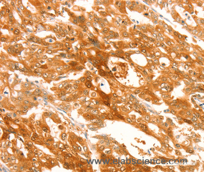 Immunohistochemistry of paraffin-embedded Human gasrtic cancer tissue using TRPM7 Polyclonal Antibody at dilution 1:30
