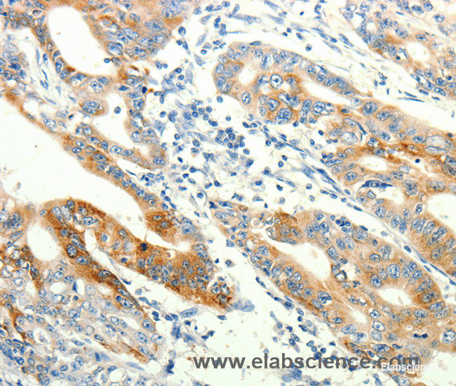 Immunohistochemistry of paraffin-embedded Human gasrtic cancer tissue using TRPA1 Polyclonal Antibody at dilution 1:60