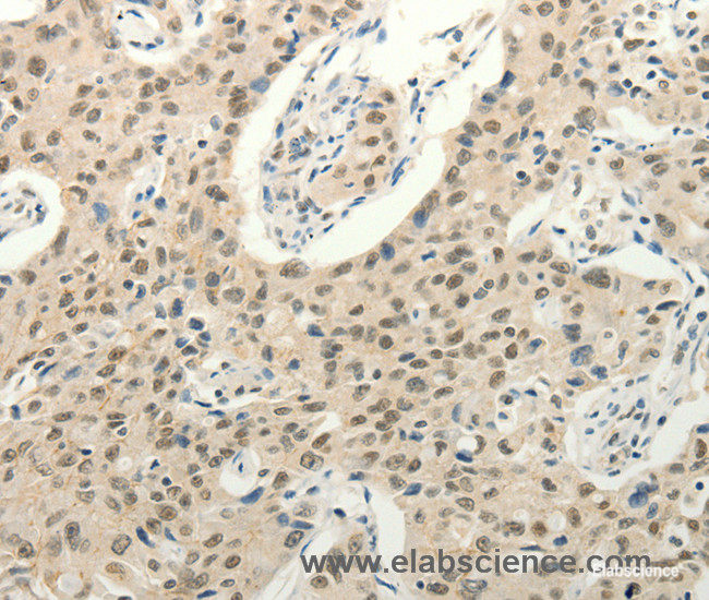 Immunohistochemistry of paraffin-embedded Human lung cancer tissue using Frizzled 10 Polyclonal Antibody at dilution 1:50