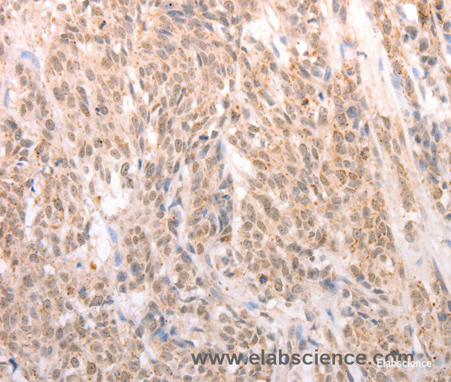 Immunohistochemistry of paraffin-embedded Human liver cancer tissue using ACIN1 Polyclonal Antibody at dilution 1:80