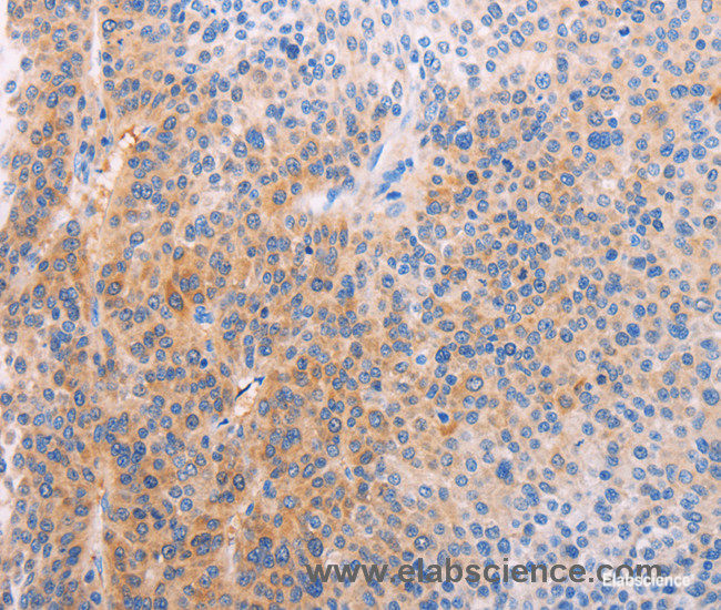 Immunohistochemistry of paraffin-embedded Human liver cancer tissue using ADHFE1 Polyclonal Antibody at dilution 1:60