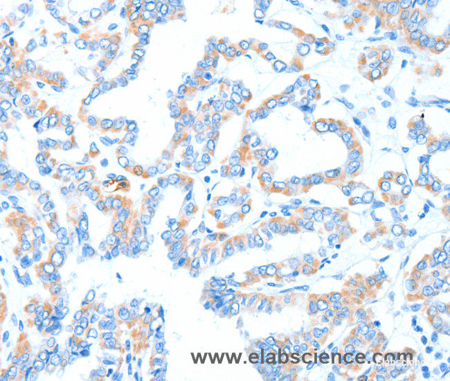 Immunohistochemistry of paraffin-embedded Human thyroid cancer tissue using GPT Polyclonal Antibody at dilution 1:55