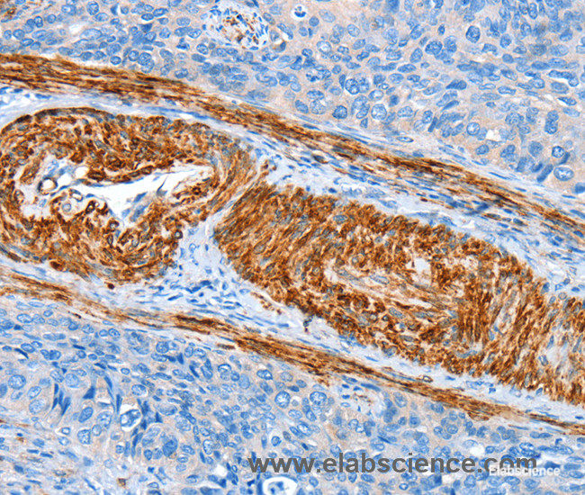 Immunohistochemistry of paraffin-embedded Human cervical cancer tissue using AARS Polyclonal Antibody at dilution 1:60