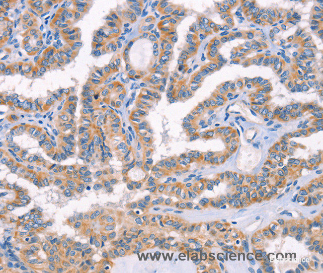 Immunohistochemistry of paraffin-embedded Human thyroid cancer tissue using AP1B1 Polyclonal Antibody at dilution 1:70
