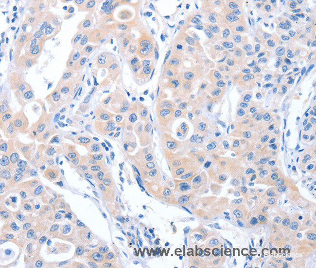 Immunohistochemistry of paraffin-embedded Human lung cancer tissue using ARHGEF6 Polyclonal Antibody at dilution 1:70