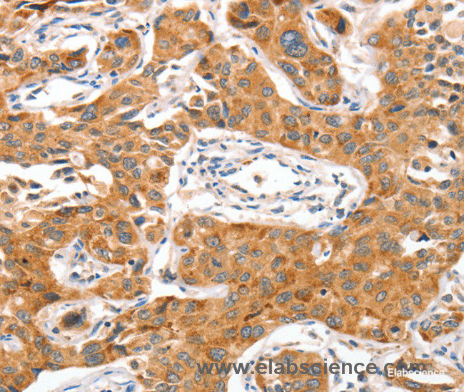Immunohistochemistry of paraffin-embedded Human lung cancer tissue using NUAK1 Polyclonal Antibody at dilution 1:70