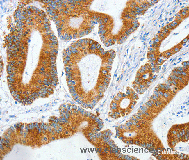 Immunohistochemistry of paraffin-embedded Human colon cancer tissue using MANF Polyclonal Antibody at dilution 1:50