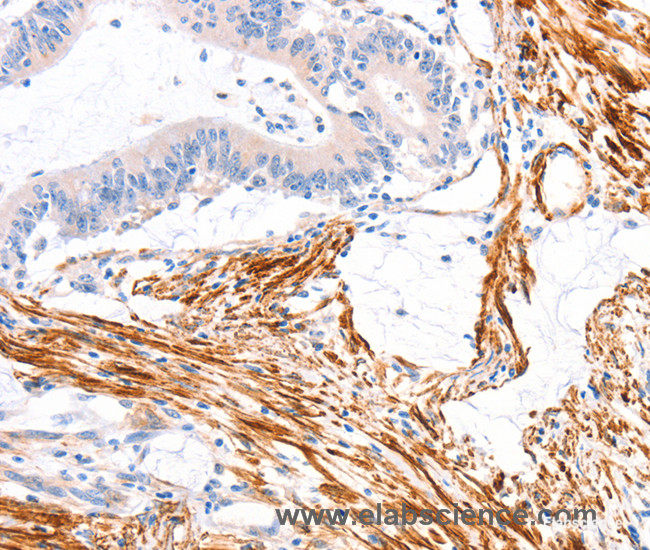Immunohistochemistry of paraffin-embedded Human colon cancer tissue using ARAP1 Polyclonal Antibody at dilution 1:80