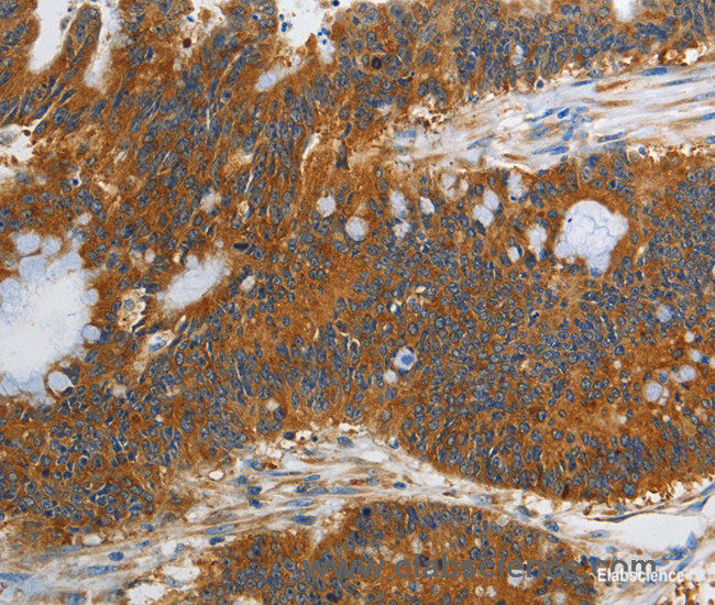 Immunohistochemistry of paraffin-embedded Human colon cancer tissue using PI 3 Kinase Class 3 Polyclonal Antibody at dilution 1:40