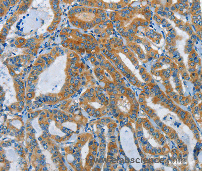 Immunohistochemistry of paraffin-embedded Human thyroid cancer tissue using DDAH1 Polyclonal Antibody at dilution 1:55