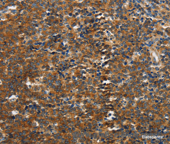Immunohistochemistry of paraffin-embedded Human lymphoma tissue using PIK3R4 Polyclonal Antibody at dilution 1:85