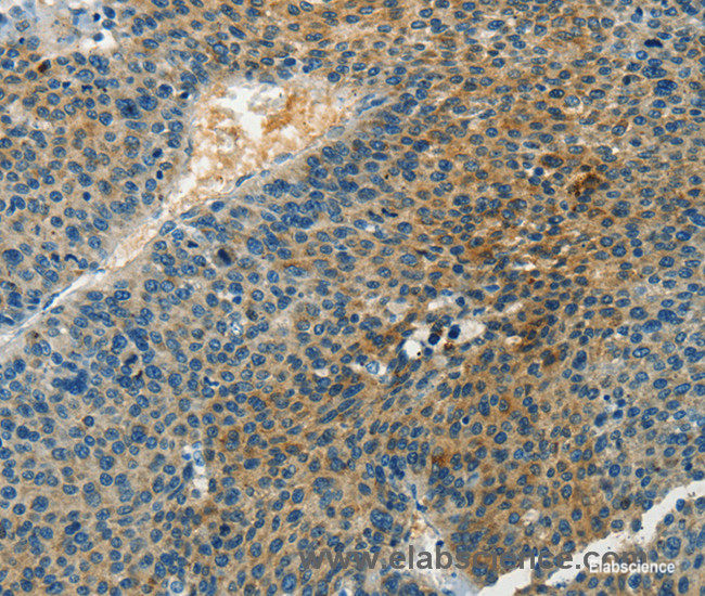 Immunohistochemistry of paraffin-embedded Human liver cancer tissue using DGK beta Polyclonal Antibody at dilution 1:60