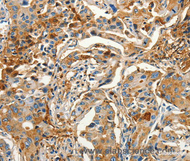 Immunohistochemistry of paraffin-embedded Human lung cancer tissue using CALCA Polyclonal Antibody at dilution 1:60