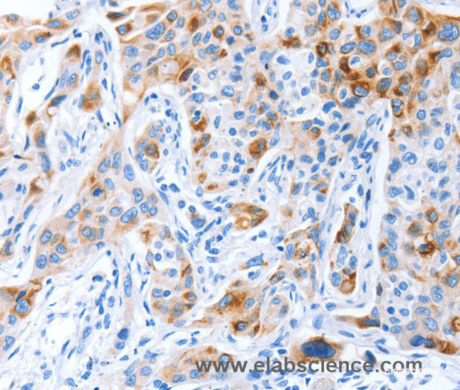 Immunohistochemistry of paraffin-embedded Human lung cancer tissue using CD133 Polyclonal Antibody at dilution 1:70