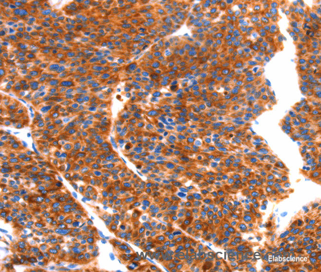 Immunohistochemistry of paraffin-embedded Human liver cancer tissue using SEPT4 Polyclonal Antibody at dilution 1:50