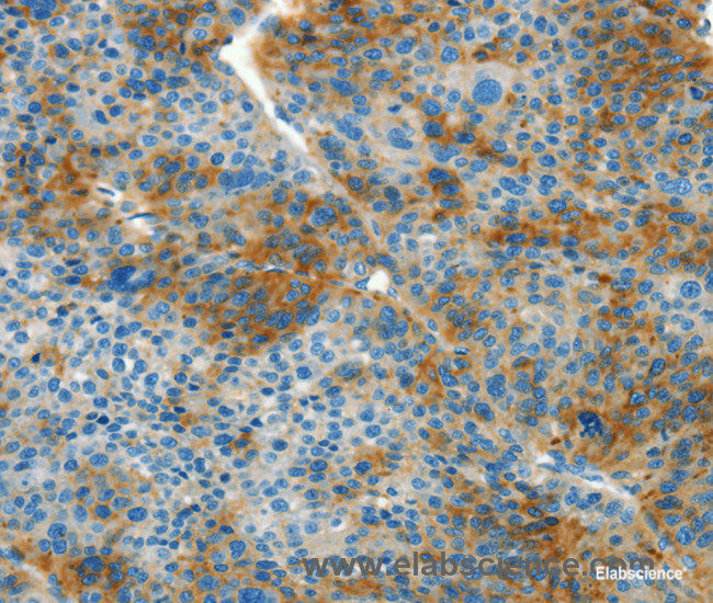 Immunohistochemistry of paraffin-embedded Human liver cancer tissue using L1CAM Polyclonal Antibody at dilution 1:40