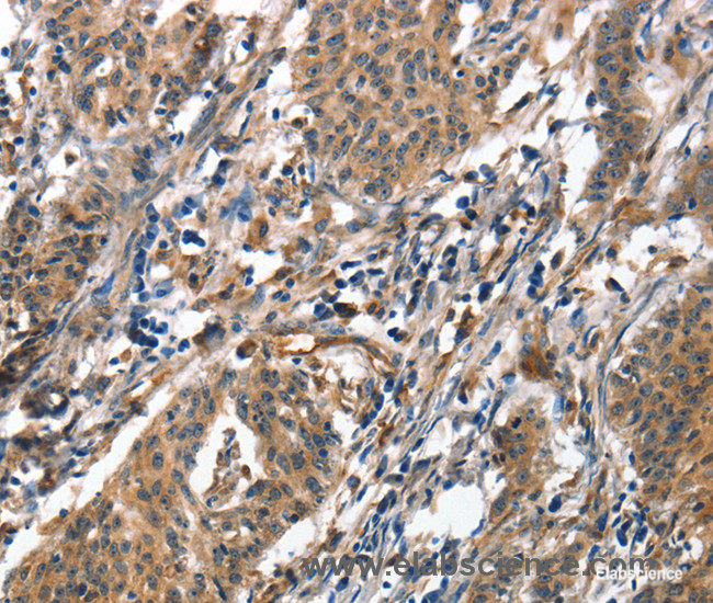 Immunohistochemistry of paraffin-embedded Human gasrtic cancer tissue using ALOX15 Polyclonal Antibody at dilution 1:50