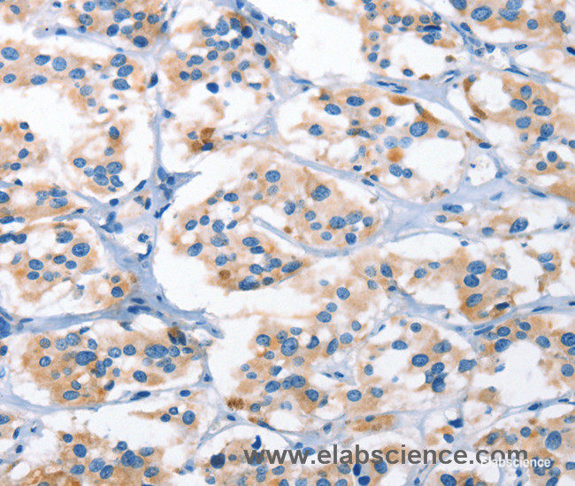 Immunohistochemistry of paraffin-embedded Human thyroid cancer tissue using AHR Polyclonal Antibody at dilution 1:50